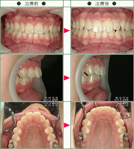 出っ歯矯正症例 上だけの症例 19歳以下 1