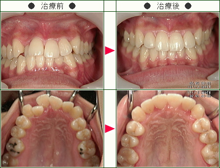 歯のデコボコ矯正症例(さおり様　２１歳　女性)