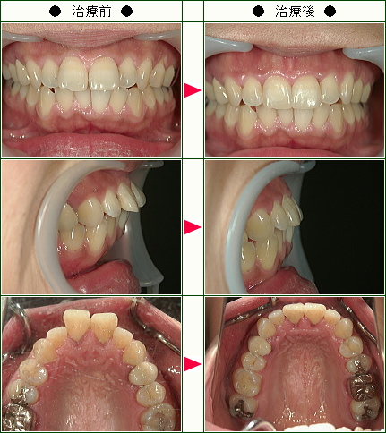 出っ歯矯正症例(佐々木様　３５歳　女性)