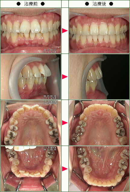歯のデコボコ矯正症例(佐々木様　３７歳　女性)
