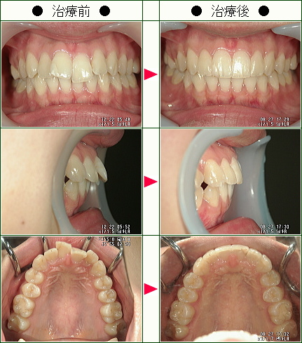 歯のデコボコ矯正症例(ささやん様　１９歳　女性)
