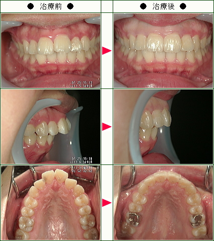 出っ歯矯正症例(佐竹様　１７歳　女性)