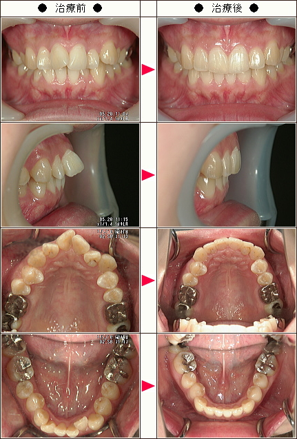 出っ歯矯正症例［佐藤様　２３歳　女性］