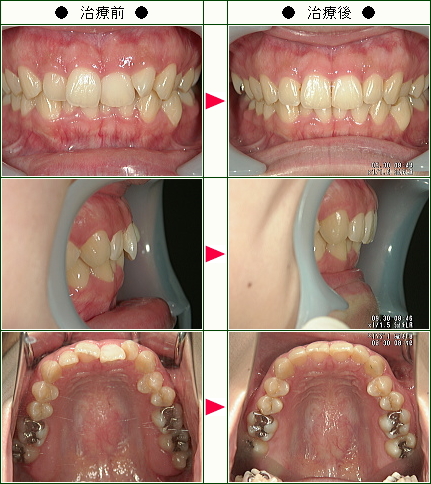 歯のデコボコ矯正症例(佐藤様　２４歳　女性)