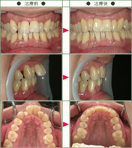 出っ歯矯正症例(佐藤様　３４歳　男性)
