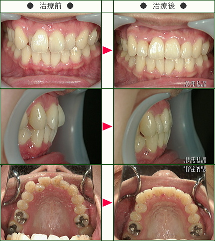 歯のデコボコ矯正症例(佐藤様　３６歳　女性)