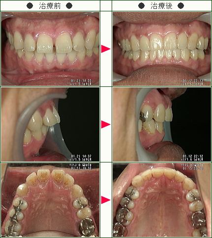 出っ歯矯正症例(サトウ様　４６歳　男性)