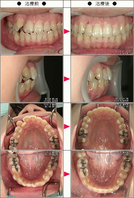 歯のデコボコ矯正症例［サトピン様　２５歳　女性］