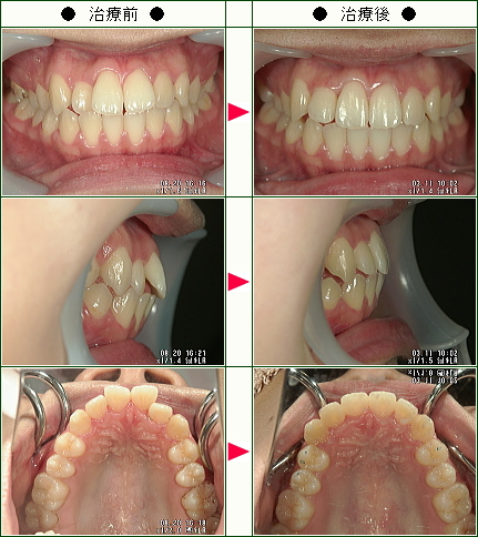 歯のデコボコ矯正症例(澤谷様　２０歳　女性)