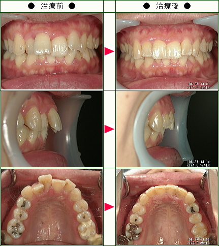 歯のデコボコ矯正症例(Ｓ.Ｆ様　３４歳　女性)