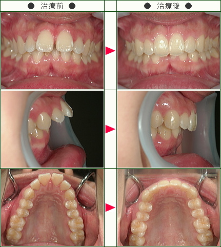 出っ歯矯正症例(Ｓ.Ｈ様　２１歳　女性)