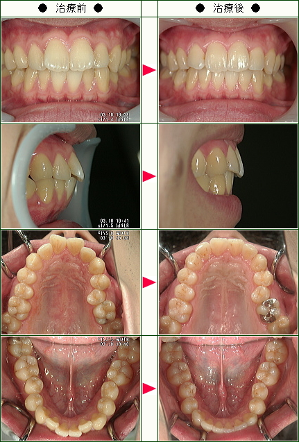 出っ歯矯正症例(Ｓ．Ｈ様　２５歳　男性)