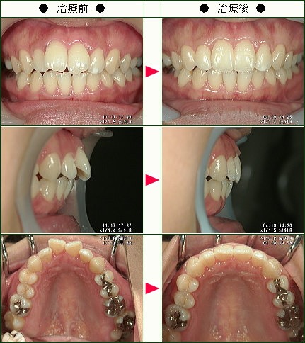 歯のデコボコ矯正症例(Ｓ．Ｈ様　２６歳　女性)