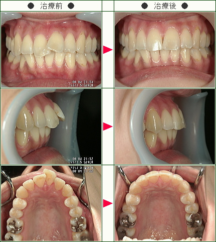 出っ歯矯正症例(Ｓ.Ｈ様　２７歳　女性)