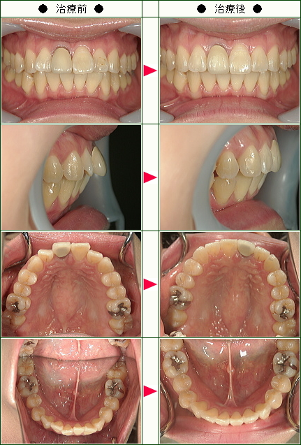 出っ歯矯正症例(Ｓ.Ｈ様　３６歳　女性)