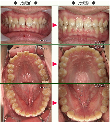 前歯のすきっ歯矯正症例(志賀様　１８歳　男性)