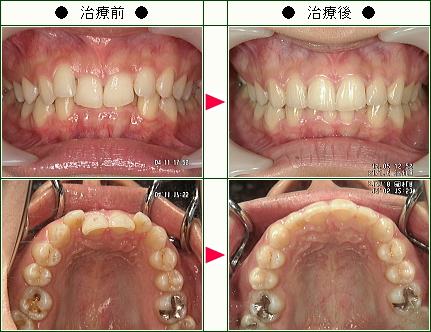 歯のデコボコ矯正症例(志穂様　２５歳　女性)