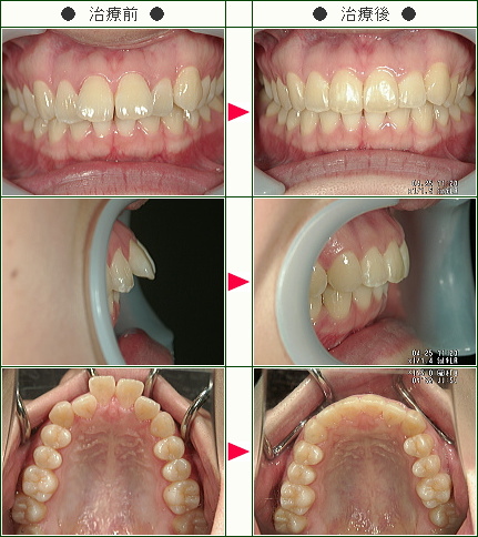 出っ歯矯正症例(清水様　２７歳　女性)