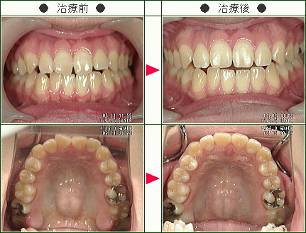 歯のデコボコ矯正症例(下村様　２３歳　女性)