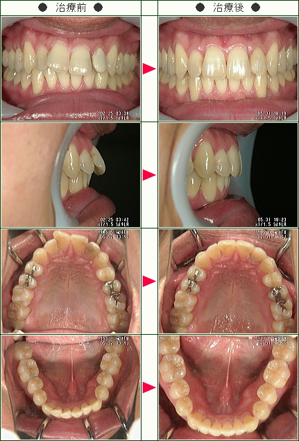 出っ歯矯正症例(ｓｈｉｎｇｏ様　３６歳　男性)