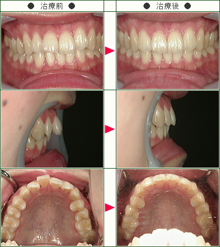 歯のデコボコ矯正症例(Ｓ.Ｉ様　２１歳　女性)