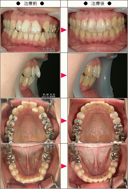 歯のデコボコ矯正症例［Ｓ.Ｉ様　３４歳　女性］