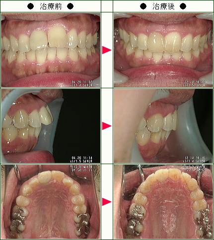 歯のデコボコ矯正症例(重川様　３１歳　男性)