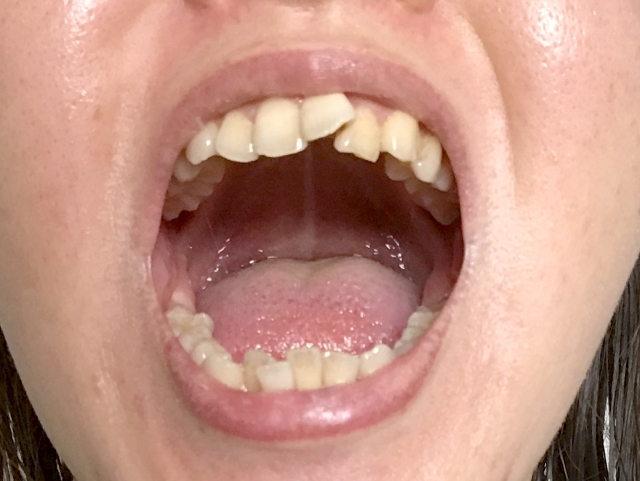 ガタガタ歯並びの特徴