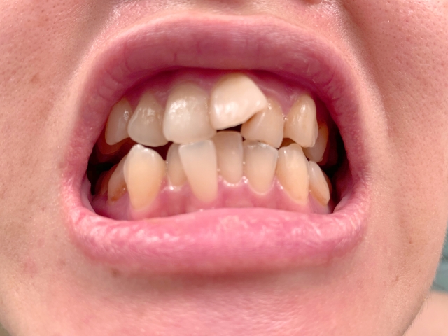 親知らずが前歯に及ぼす影響