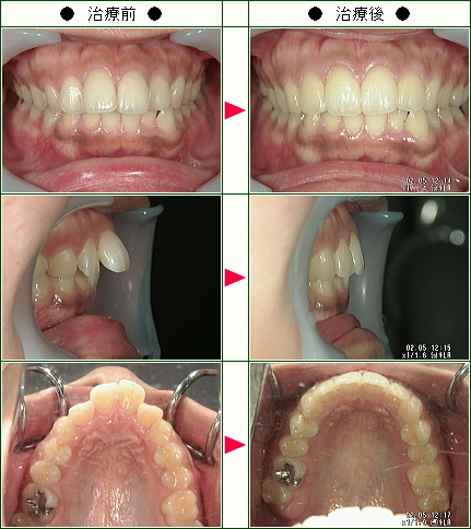 出っ歯矯正症例(Ｓ.Ｋ様　２３歳　女性)