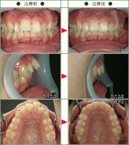 出っ歯矯正症例(Ｓ・Ｋ様　２４歳　女性)