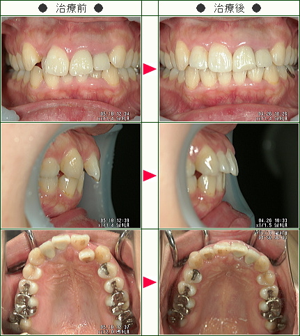 歯のデコボコ矯正症例(Ｓ・Ｋ様　３２歳　女性)