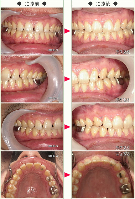 前歯のすきっ歯矯正症例(Ｓ．Ｋ．様　３８歳　男性)