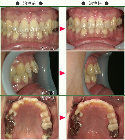 出っ歯矯正症例(Ｓ.Ｋ様　４８歳　男性)