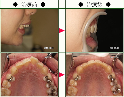 歯のデコボコ矯正症例(Ｓ.Ｍ.様　２２歳　女性)