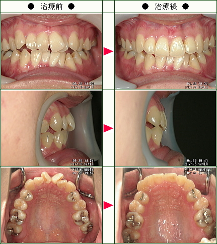 歯のデコボコ矯正症例(Ｓ・Ｍ様　２５歳　女性)