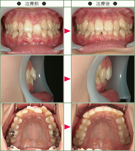 歯のデコボコ矯正症例(Ｓ.Ｍ様　２８歳　女性)