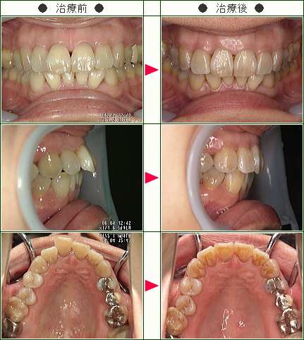 歯のデコボコ矯正症例(Ｓ・Ｍ様　４３歳　女性)