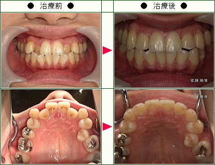歯のデコボコ矯正症例(Ｓ．Ｎ．様　２４歳　女性)