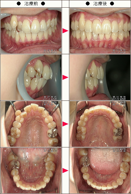 歯のデコボコ矯正症例［ＳＮ様　３１歳　女性］