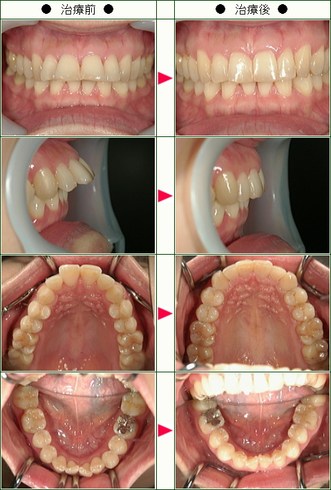 出っ歯矯正症例(Ｓ.Ｎ様　３６歳　女性)