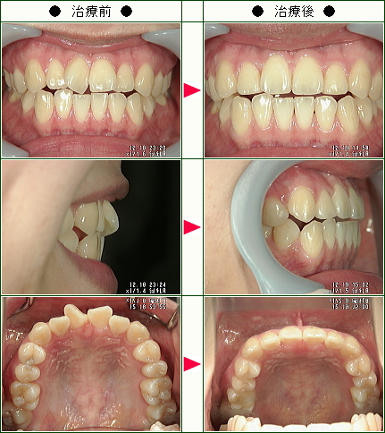 歯のデコボコ矯正症例(Ｓ.Ｏ様　２４歳　女性)