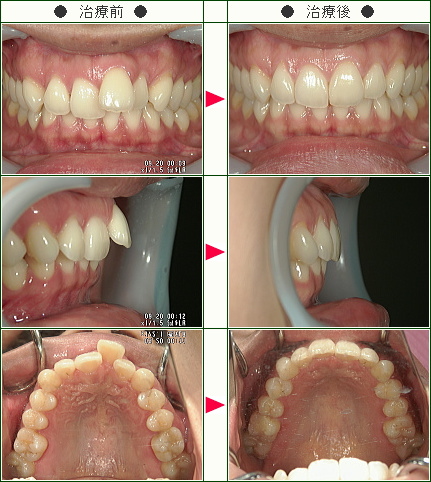 歯のデコボコ矯正症例(Ｓ.Ｏ様　２８歳　女性)