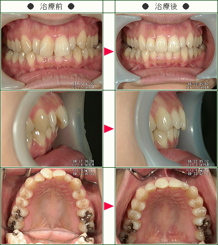 歯のデコボコ矯正症例(そのだ様　３１歳　女性)