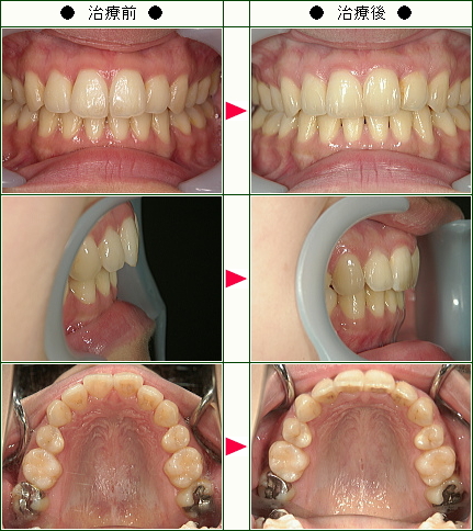歯のデコボコ矯正症例(Ｓ．Ｒ様　２８歳　女性)