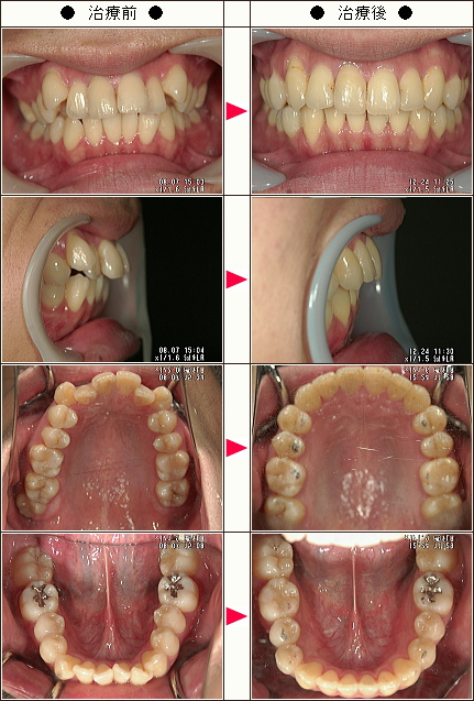 歯のデコボコ矯正症例［Ｓ・Ｓ様　２１歳　男性］