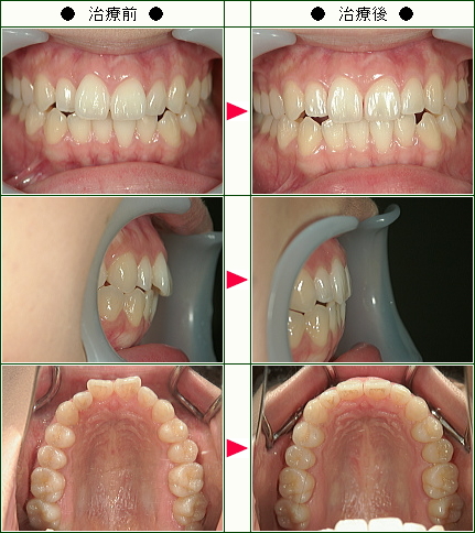 歯のデコボコ矯正症例(Ｓ.Ｓ様　２２歳　女性)