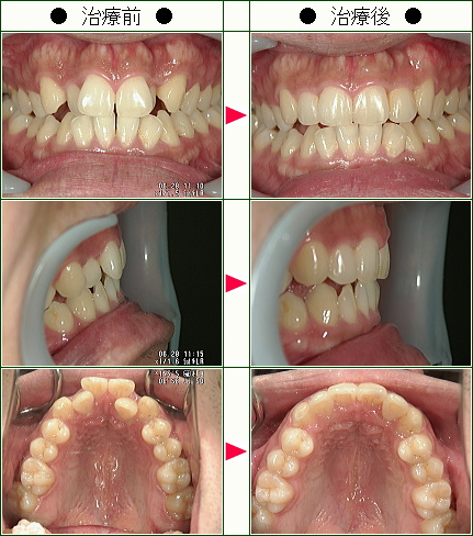 歯のデコボコ矯正症例(Ｓ・Ｓ様　２７歳　男性)