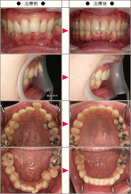 歯のデコボコ矯正症例［Ｓ．Ｓ様　３４歳　女性］