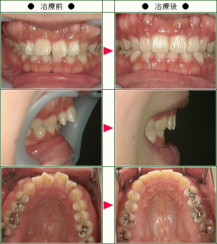 歯のデコボコ矯正症例(Ｓ・Ｓ様　３５歳　女性)